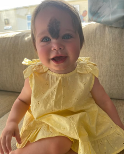 birthmark