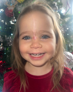 birthmark
